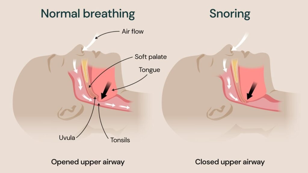 Home Sleep Study Test in Nellore explaining why people snore and airway obstruction during sleep